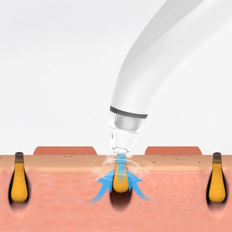 Blackhead Remover - Assortique Inc.
