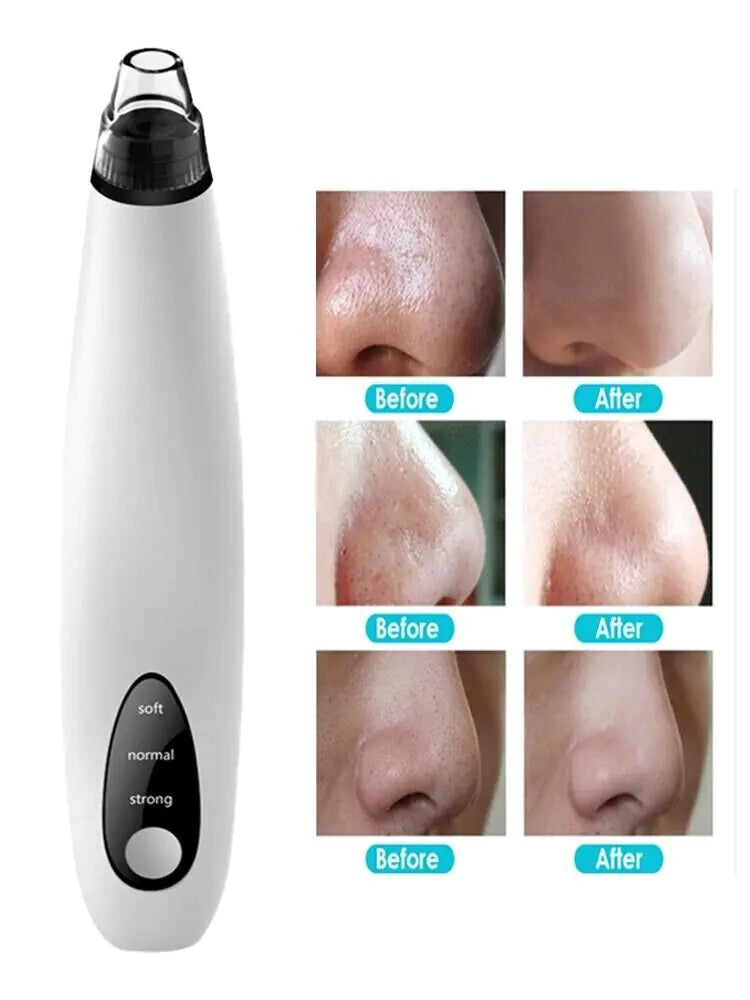 Blackhead Remover - Assortique Inc.